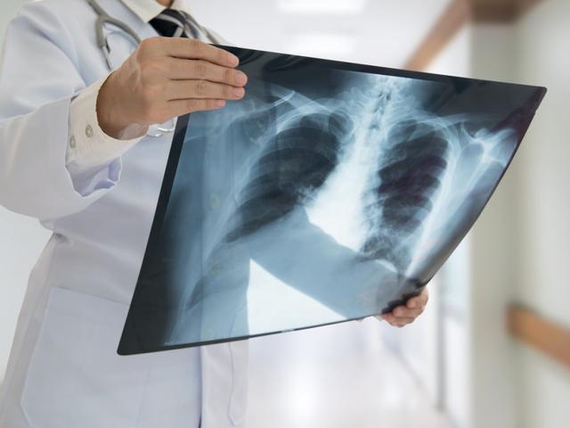 Заболеваемость воспалением лёгких в Белгородской области выросла на 42,1 %